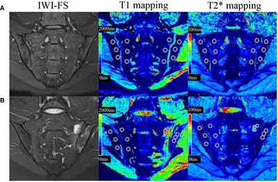 Inflammatory activity evaluation in patients with axial spondyloarthritis using MRI relaxometry and mucosal-associated invariant T cells